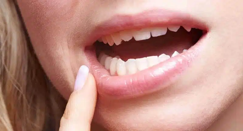En combien de temps disparaît un abcès dentaire ?